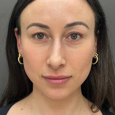 Small Changes Before & After Gallery - Patient 213801 - Image 1