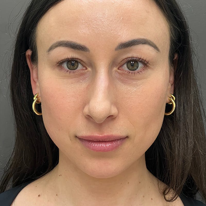 Small Changes Before & After Gallery - Patient 213801 - Image 1