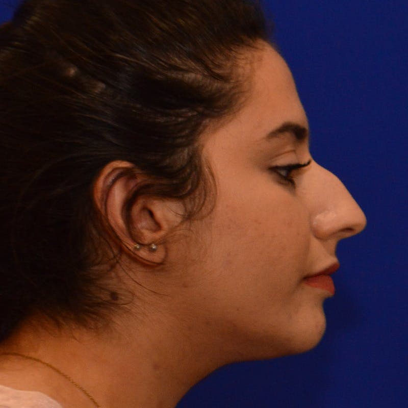 Dorsal Hump Before & After Gallery - Patient 275379 - Image 9