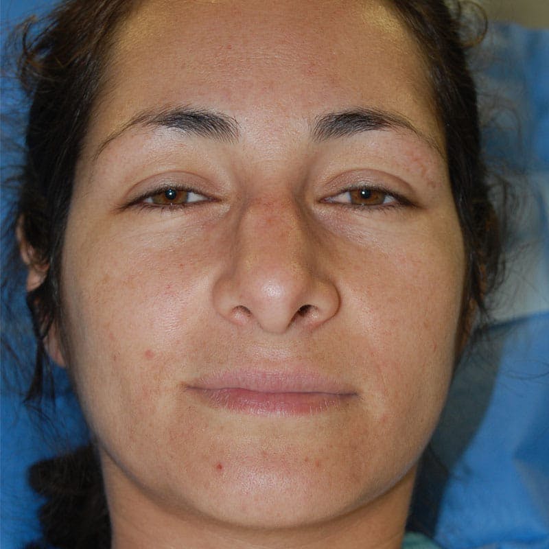 Wide Nose Before & After Gallery - Patient 173051 - Image 1