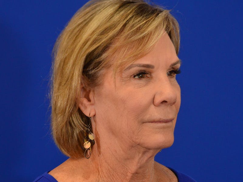 Facelift & Necklift Before & After Gallery - Patient 536616 - Image 3
