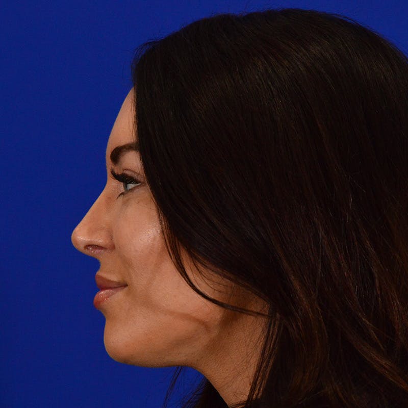 Dorsal Hump Before & After Gallery - Patient 237588 - Image 2