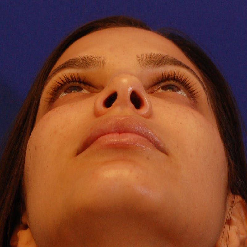 Female Rhinoplasty Before & After Gallery - Patient 396658 - Image 12