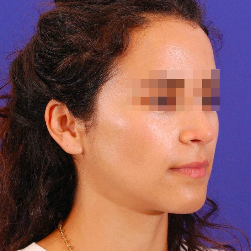 Small Changes Before & After Gallery - Patient 266763 - Image 4