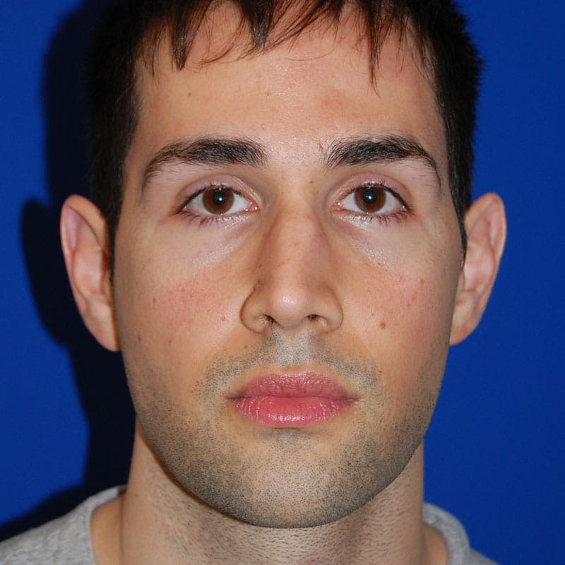 Crooked Nose Before & After Gallery - Patient 164777 - Image 1