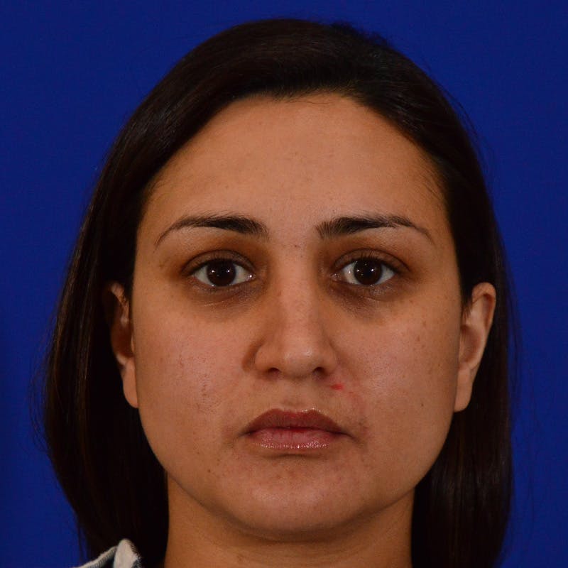 Ethnic Rhinoplasty Before & After Gallery - Patient 116783 - Image 5