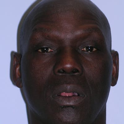 Wide Nose Before & After Gallery - Patient 129259 - Image 2