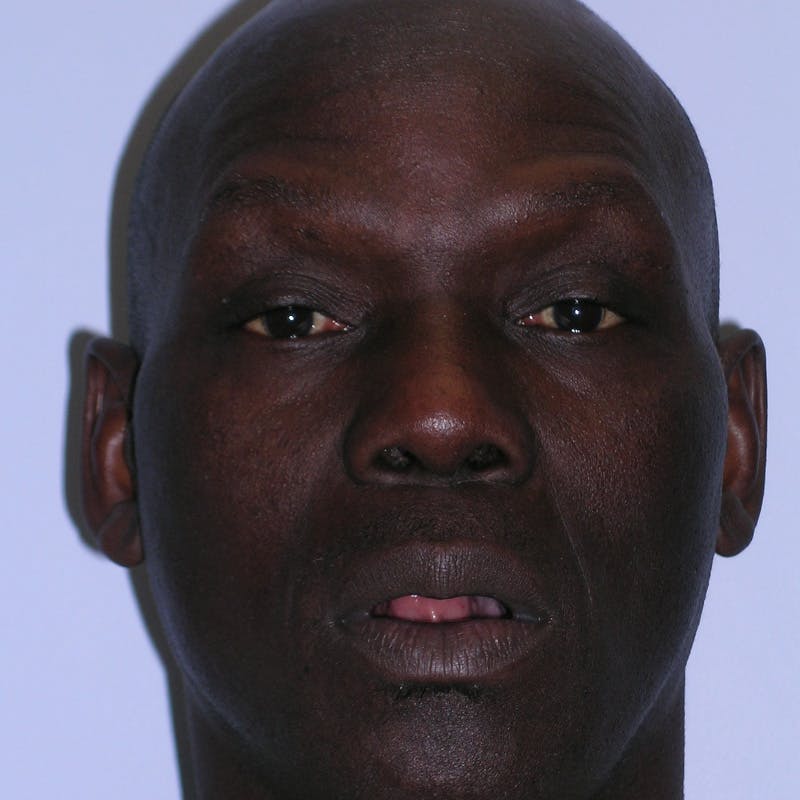 Wide Nose Before & After Gallery - Patient 129259 - Image 2