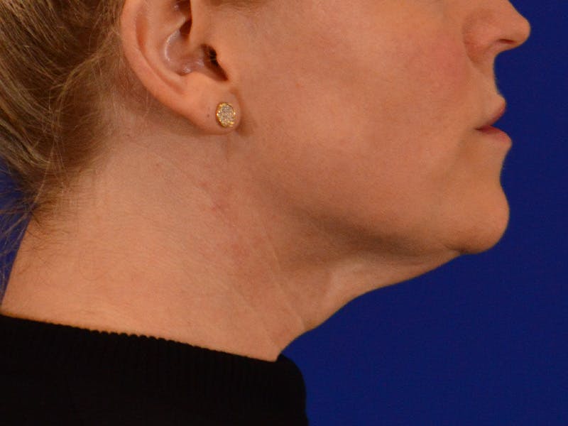 Facelift & Necklift Before & After Gallery - Patient 654569 - Image 5