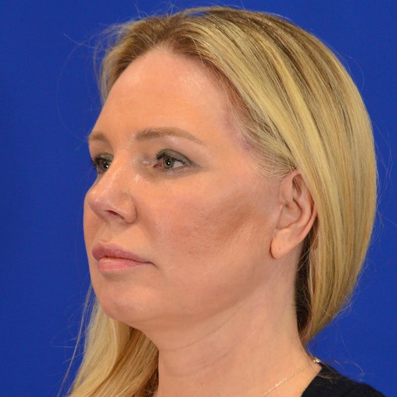Revision Rhinoplasty Before & After Gallery - Patient 156468 - Image 8