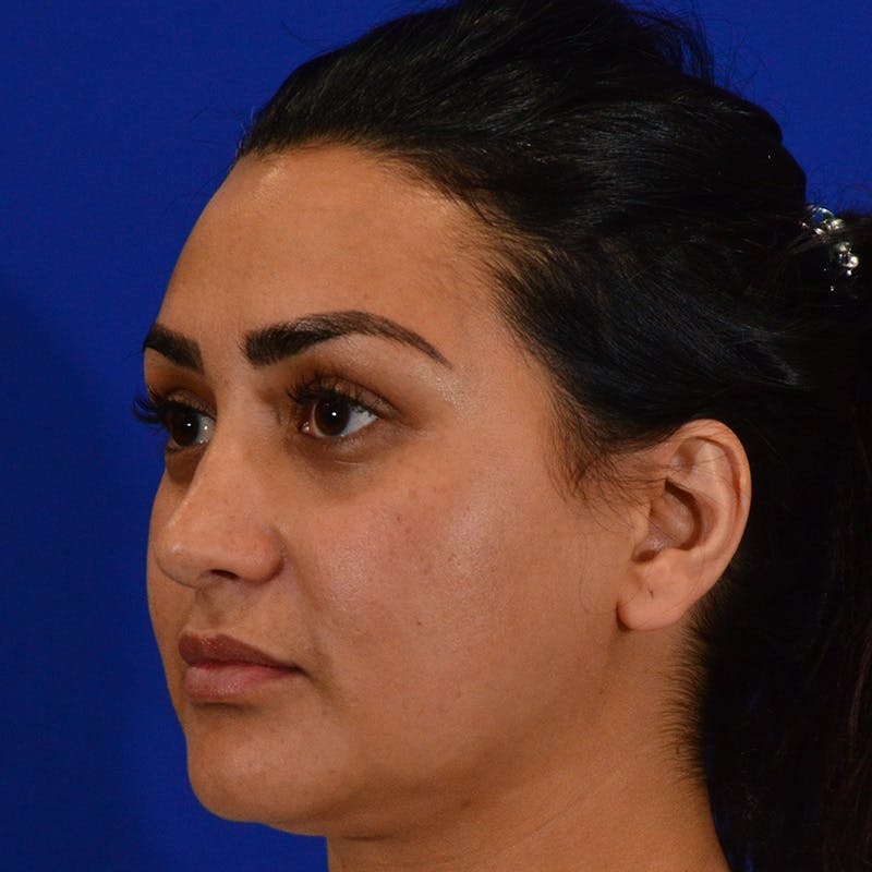 Ethnic Rhinoplasty Before & After Gallery - Patient 116783 - Image 8