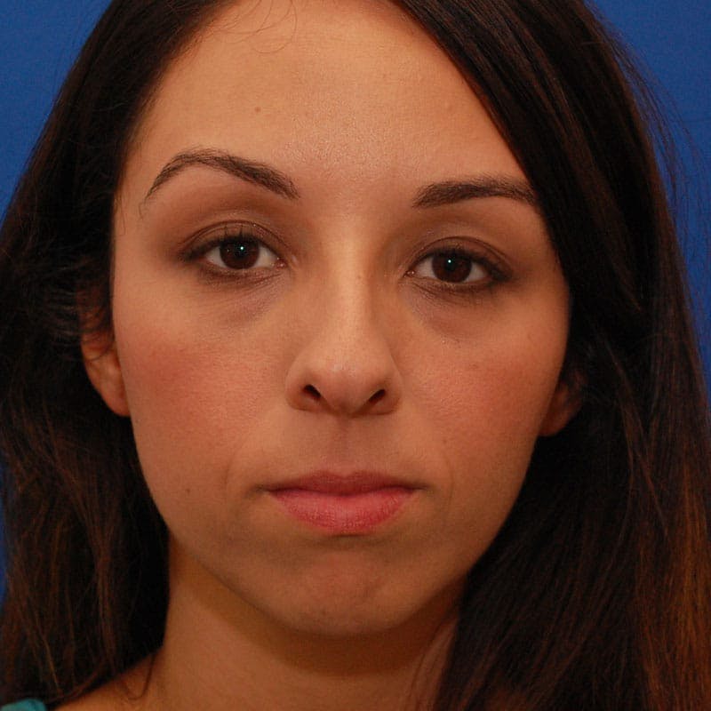 Wide Nose Before & After Gallery - Patient 308012 - Image 1