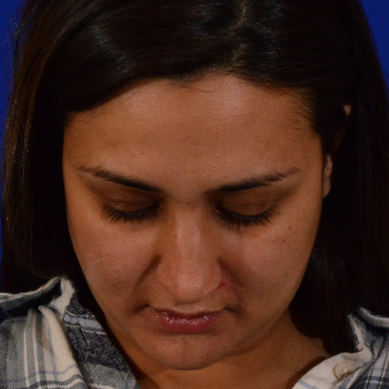Ethnic Rhinoplasty Before & After Gallery - Patient 116783 - Image 11
