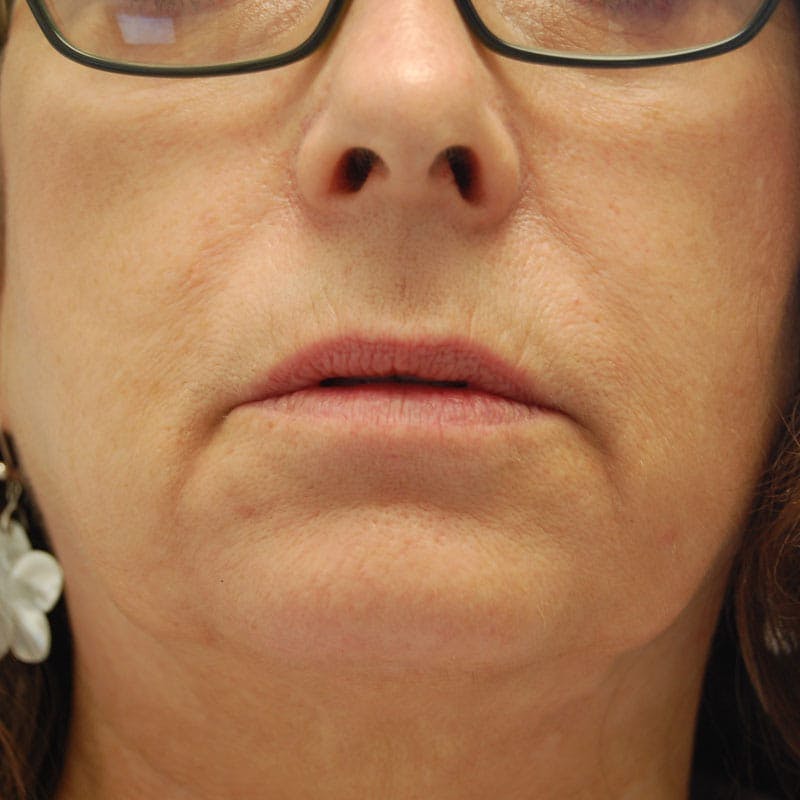 Lip Filler Before & After Gallery - Patient 299364 - Image 1