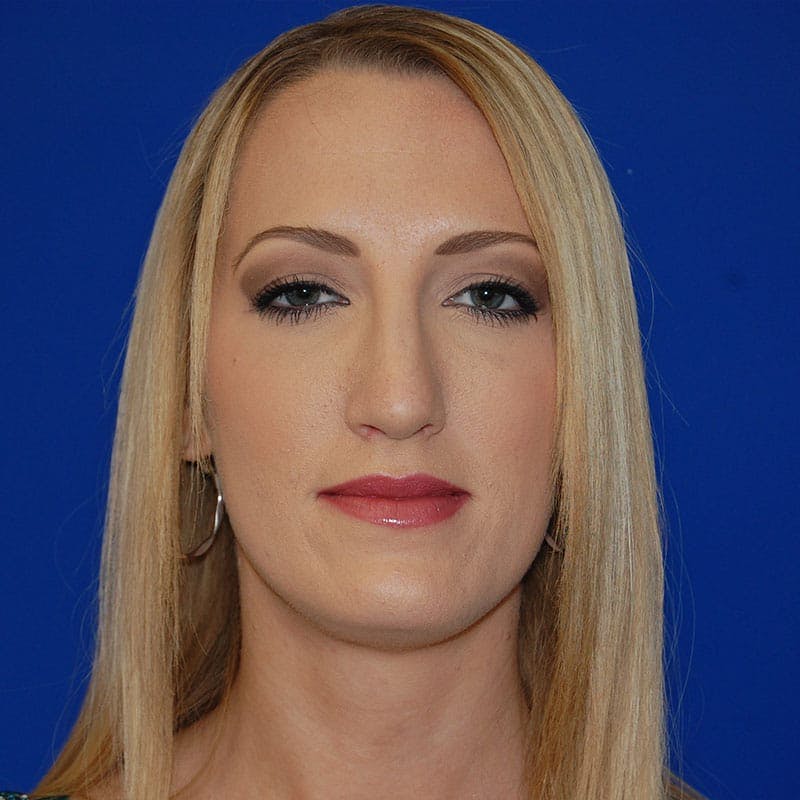 Long Nose Before & After Gallery - Patient 151681 - Image 1