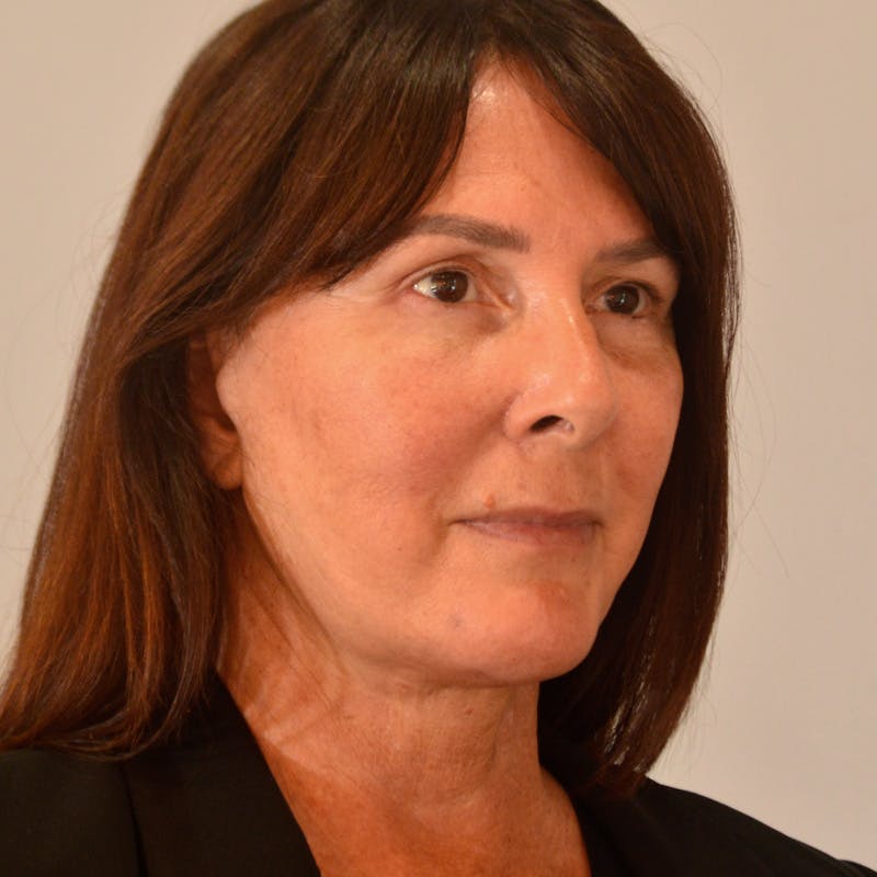 Facelift & Necklift Before & After Gallery - Patient 246000 - Image 4