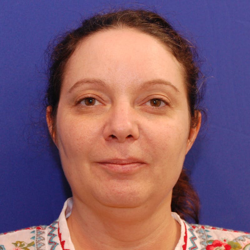 Facelift & Necklift Before & After Gallery - Patient 922406 - Image 1