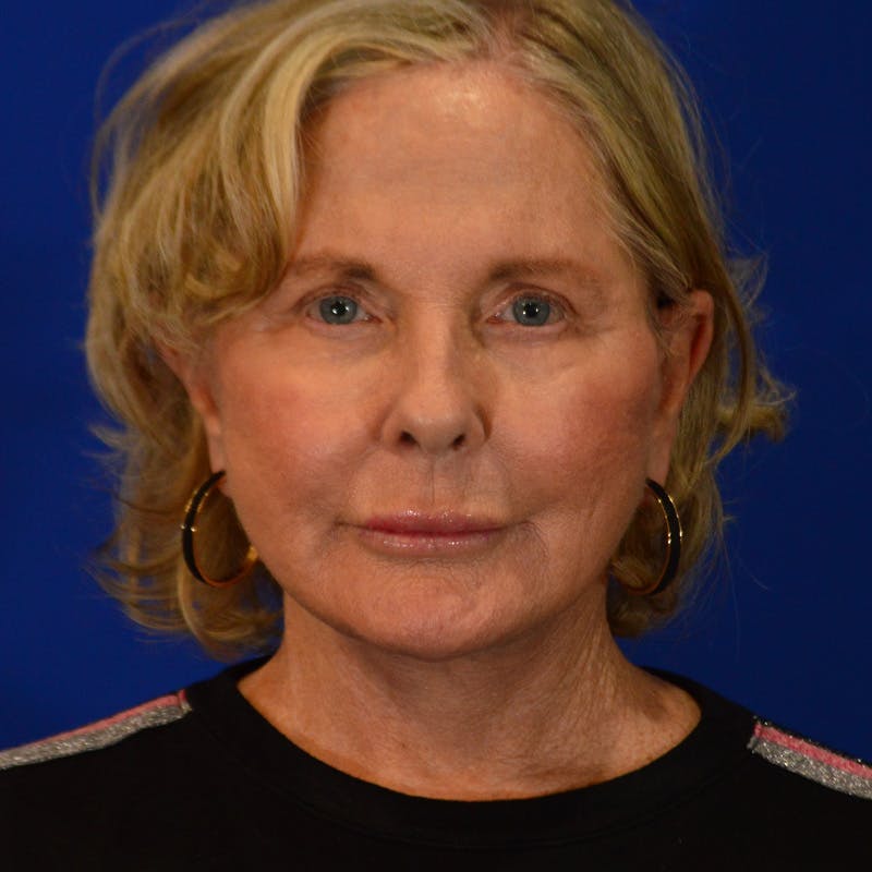 Co2 Laser Resurfacing Before & After Gallery - Patient 940417 - Image 2