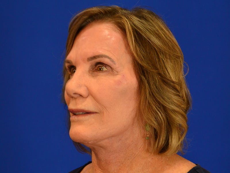 Facelift & Necklift Before & After Gallery - Patient 536616 - Image 6