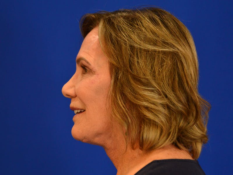 Facelift & Necklift Before & After Gallery - Patient 536616 - Image 8