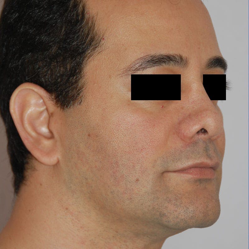 Male Rhinoplasty Before & After Gallery - Patient 785244 - Image 5