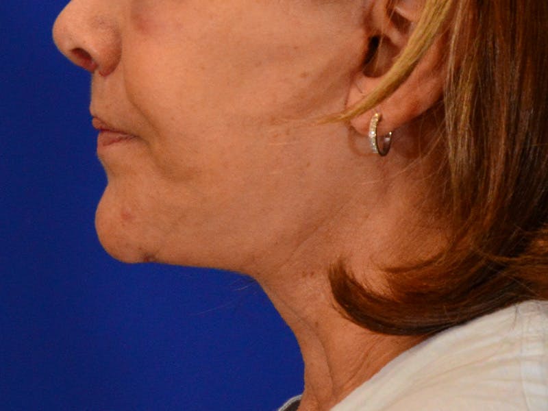 Facelift & Necklift Before & After Gallery - Patient 391454 - Image 4