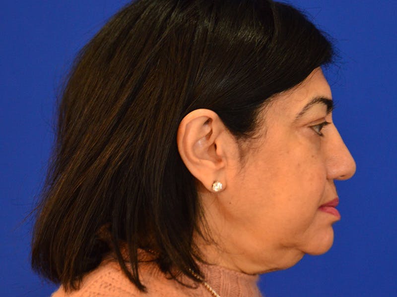 Buccal Fat Removal Before & After Gallery - Patient 351983 - Image 5