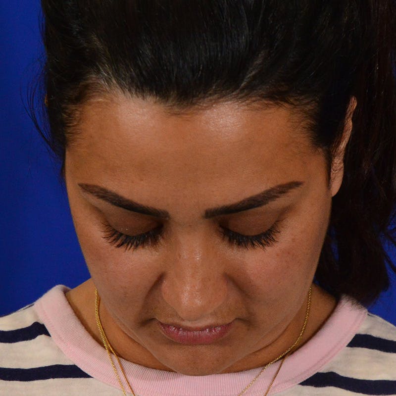 Ethnic Rhinoplasty Before & After Gallery - Patient 116783 - Image 12