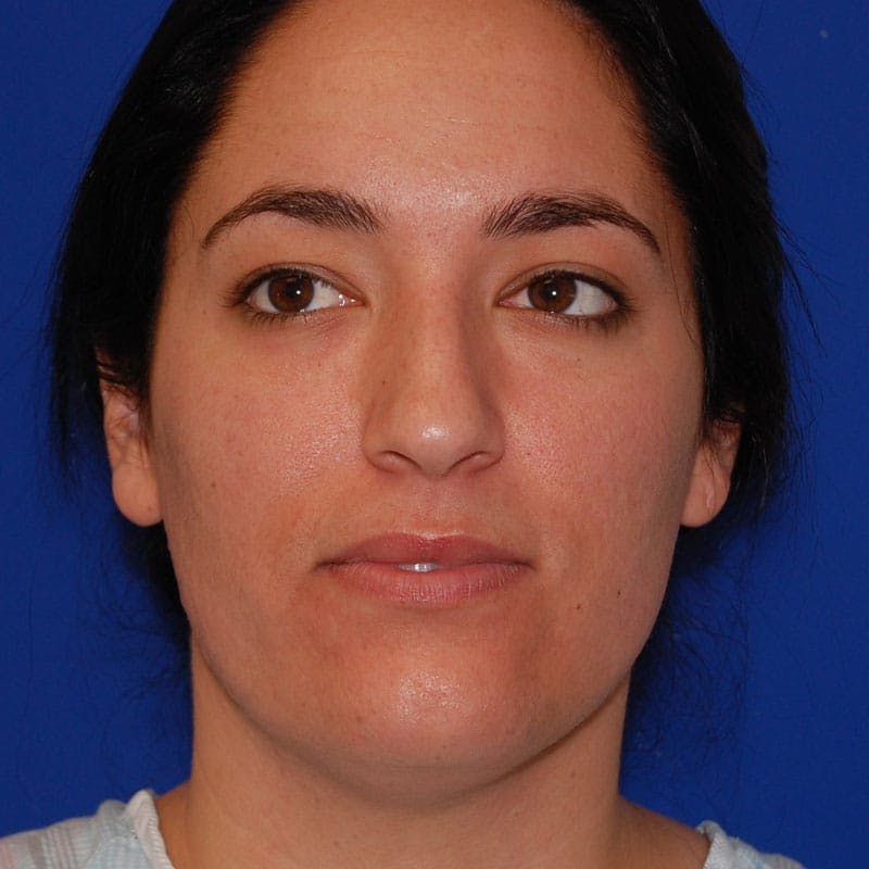 Dorsal Hump Before & After Gallery - Patient 319034 - Image 3