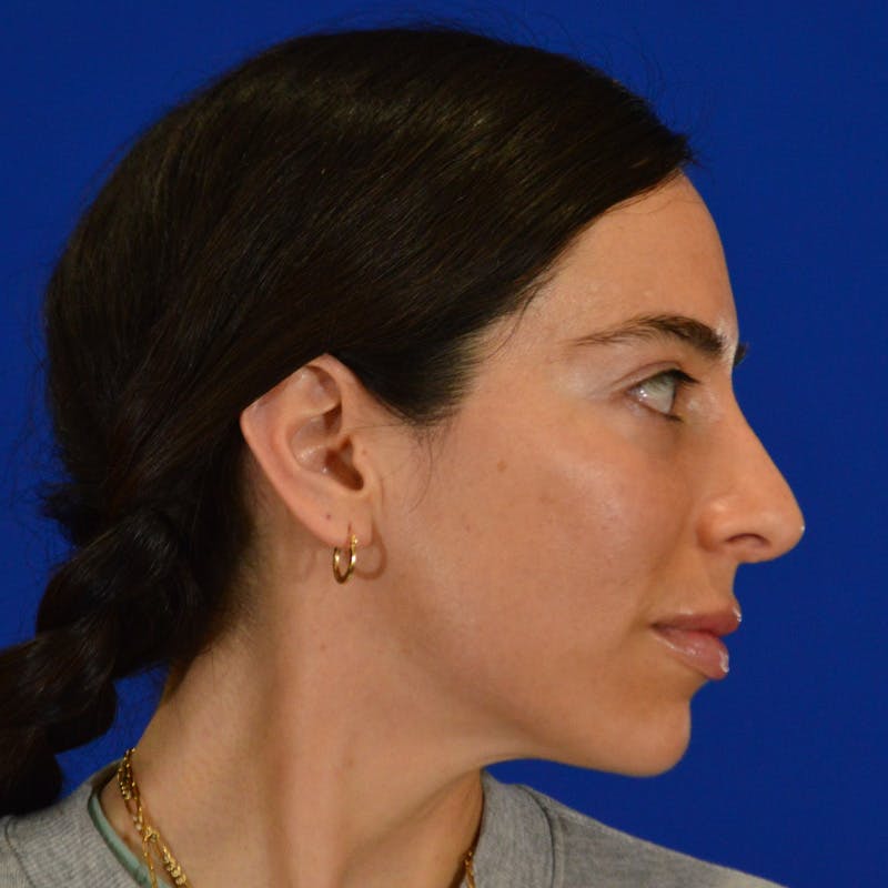 Facial Fat Grafting Before & After Gallery - Patient 411676 - Image 6