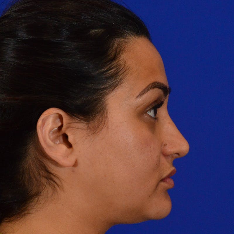 Ethnic Rhinoplasty Before & After Gallery - Patient 116783 - Image 2