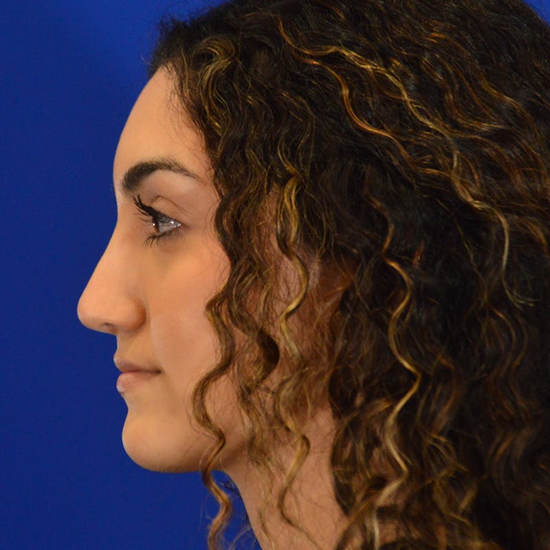 Female Rhinoplasty Before & After Gallery - Patient 224146 - Image 2