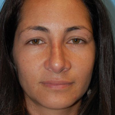 Wide Nose Before & After Gallery - Patient 173051 - Image 2