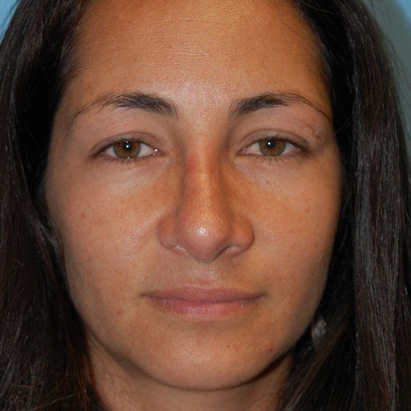 Wide Nose Before & After Gallery - Patient 173051 - Image 2