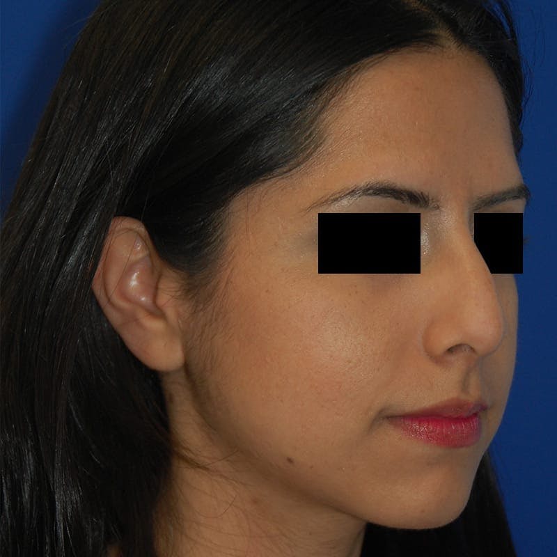 Dorsal Hump Before & After Gallery - Patient 264673 - Image 5