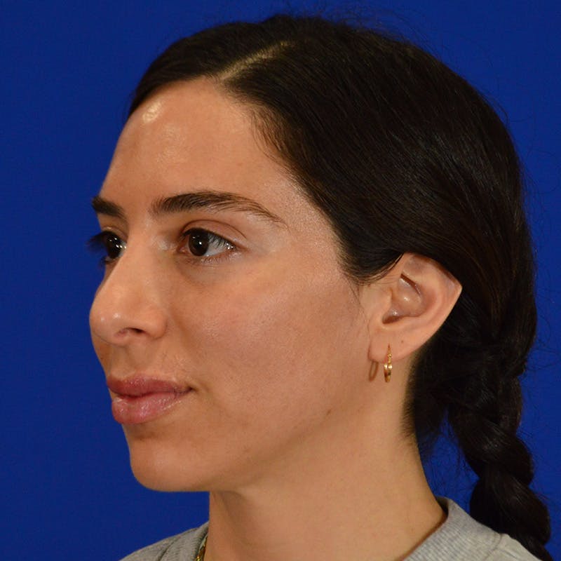 Facial Fat Grafting Before & After Gallery - Patient 411676 - Image 8