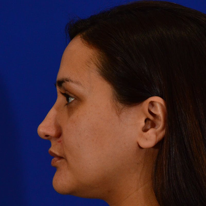 Ethnic Rhinoplasty Before & After Gallery - Patient 116783 - Image 9