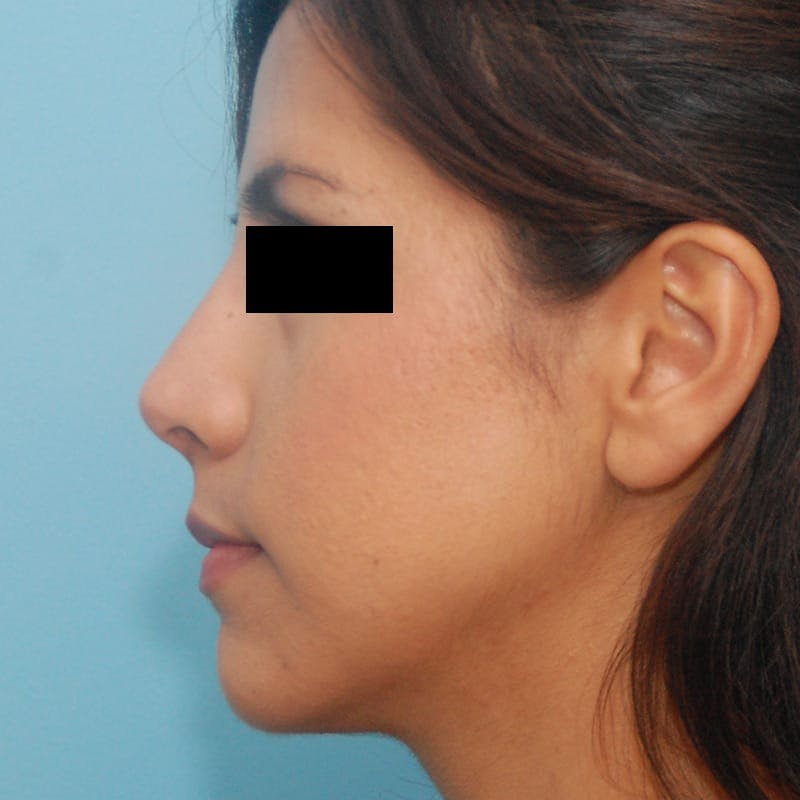 Dorsal Hump Before & After Gallery - Patient 264673 - Image 2