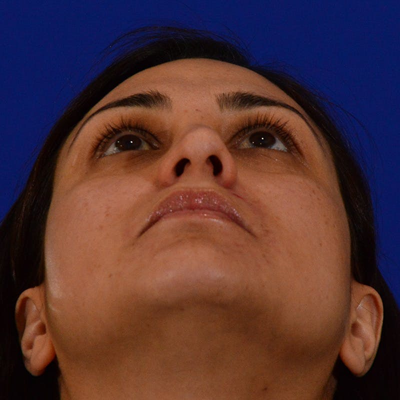 Ethnic Rhinoplasty Before & After Gallery - Patient 116783 - Image 13