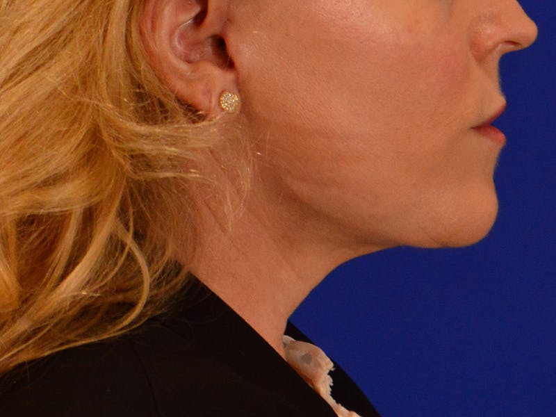 Facelift & Necklift Before & After Gallery - Patient 654569 - Image 6