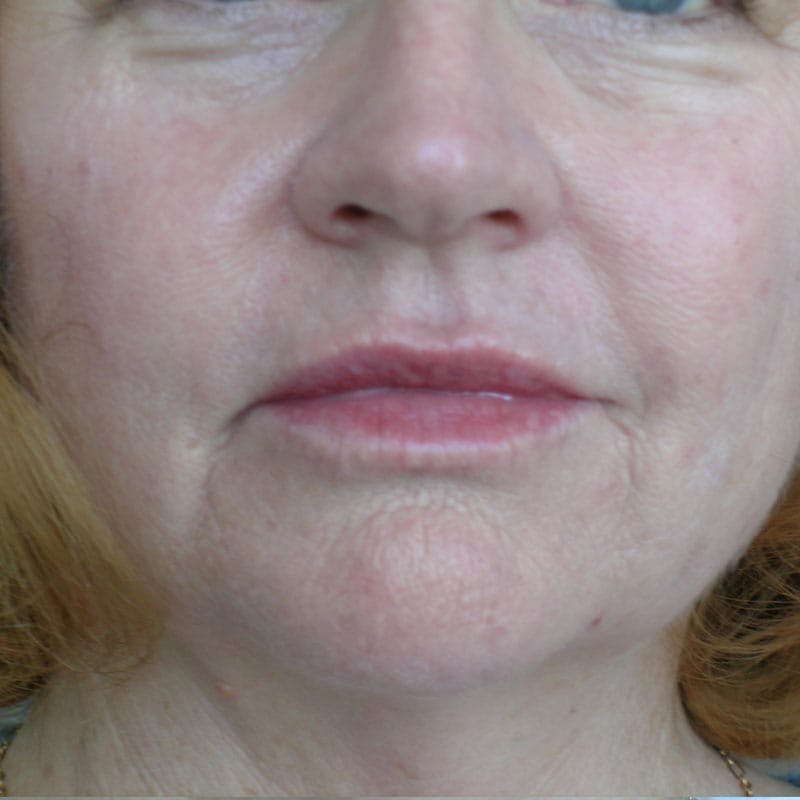 Lip Filler Before & After Gallery - Patient 307842 - Image 2