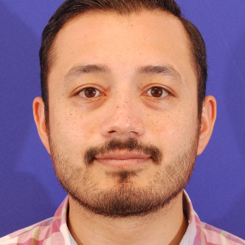 Ethnic Rhinoplasty Before & After Gallery - Patient 408370 - Image 4