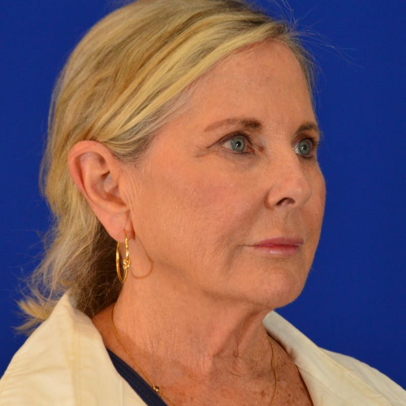 Co2 Laser Resurfacing Before & After Gallery - Patient 940417 - Image 3