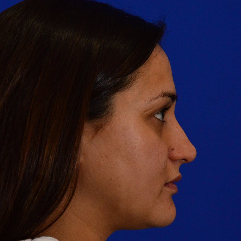 Ethnic Rhinoplasty Before & After Gallery - Patient 116783 - Image 1