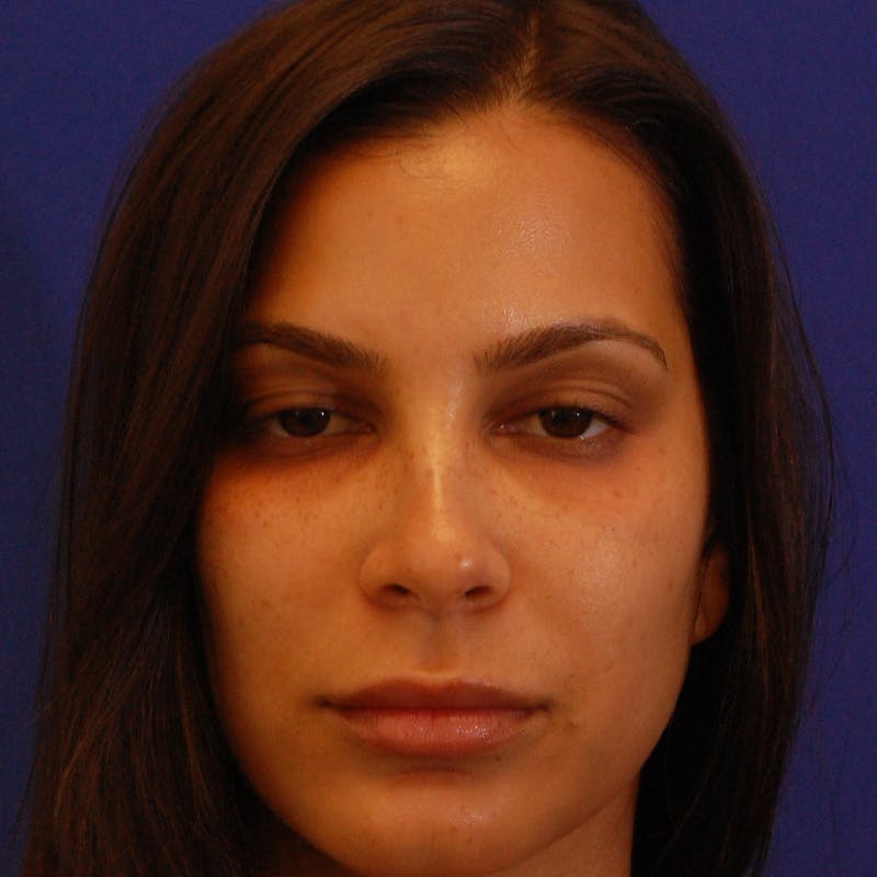Female Rhinoplasty Before & After Gallery - Patient 396658 - Image 8