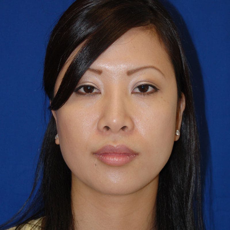 Short Nose Before & After Gallery - Patient 288711 - Image 2