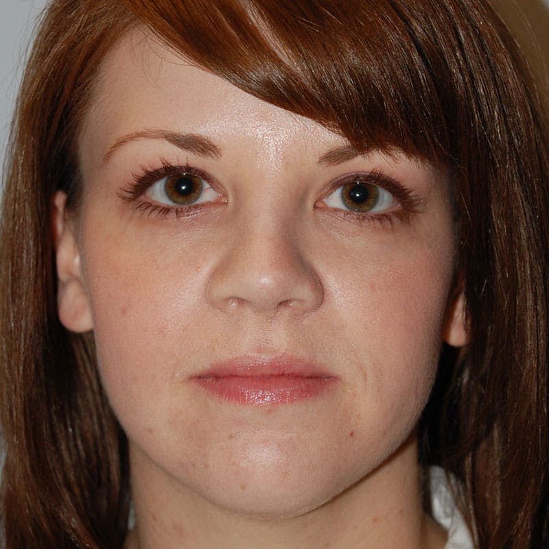 Short Nose Before & After Gallery - Patient 597359 - Image 2