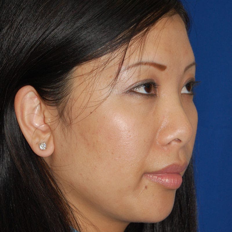 Short Nose Before & After Gallery - Patient 288711 - Image 3