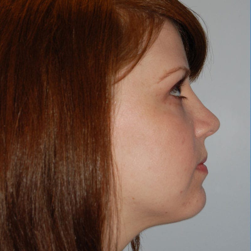 Short Nose Before & After Gallery - Patient 597359 - Image 6