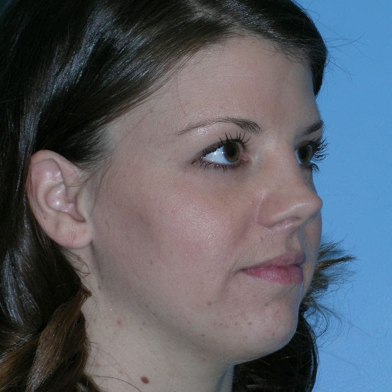 Short Nose Before & After Gallery - Patient 597359 - Image 3